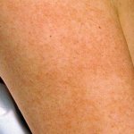 keratosis pilaris