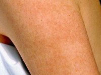 keratosis pilaris